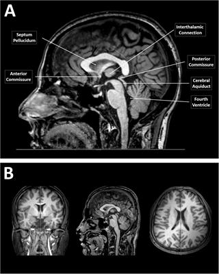 Morphometric Analysis of the Corpus Callosum According to Age and Sex in Middle Eastern Arabs: Racial Comparisons and Clinical Correlations to Autism Spectrum Disorder